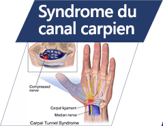 Syndrôme du canal carpien